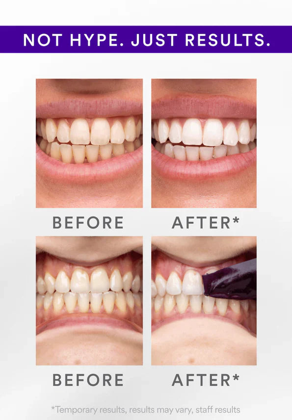 Whitening Strips: ‘’The Fast Track to a Stunning Smile!‘’
