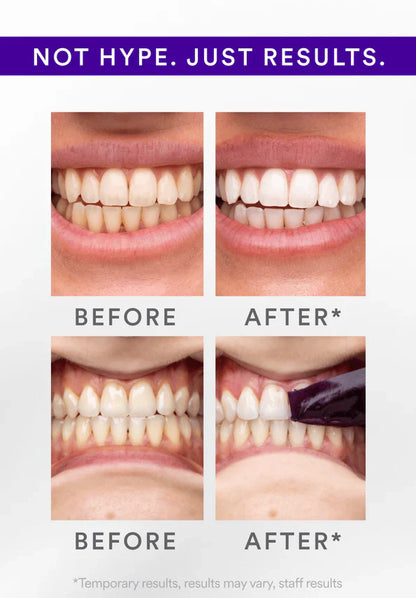 Whitening Strips: ‘’The Fast Track to a Stunning Smile!‘’
