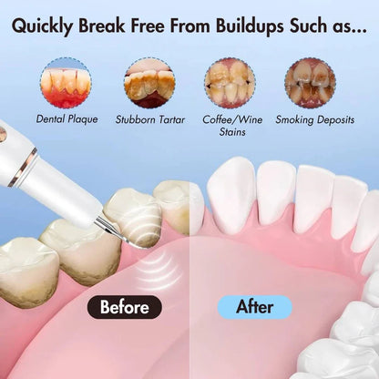 Ultrasonic Teeth Cleaner