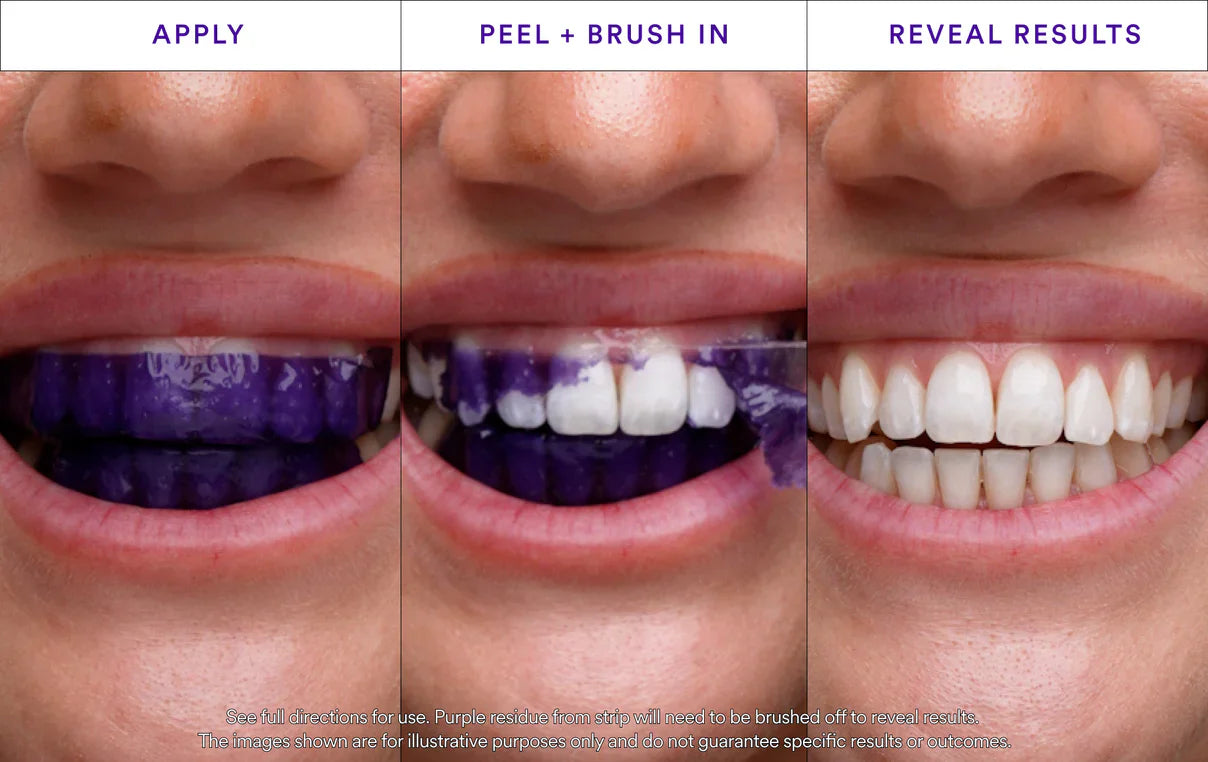 Whitening Strips: ‘’The Fast Track to a Stunning Smile!‘’